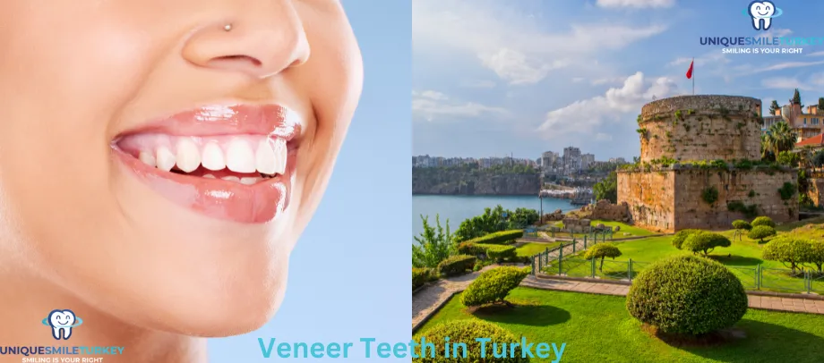 Veneer teeth in Turkey