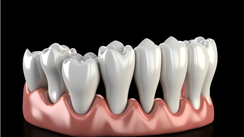 Composite fillings for receding gums