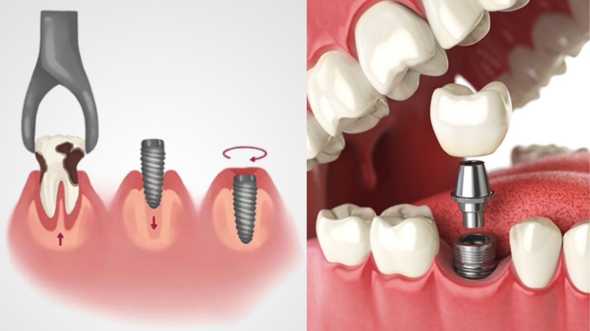 Dental implant after tooth extraction