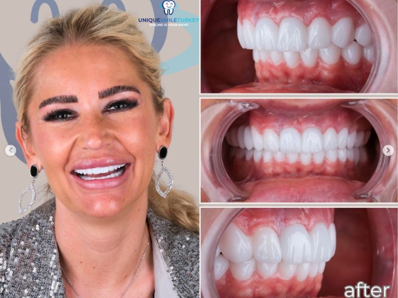 Hollywood Smile in Turkey