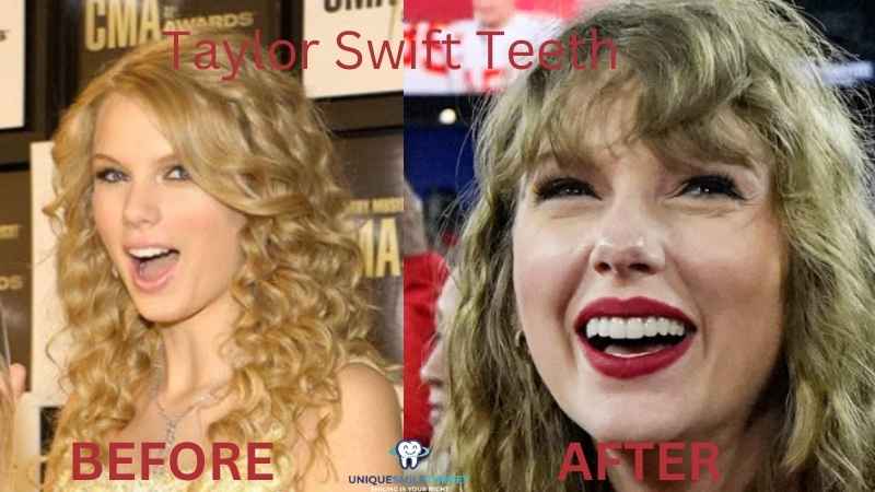 Taylor Swift Teeth Turkey