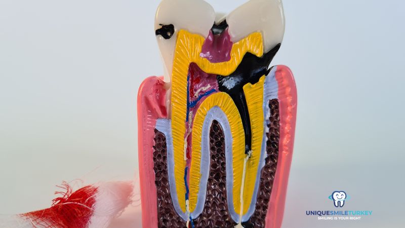 Root Canal Treatment Antalya