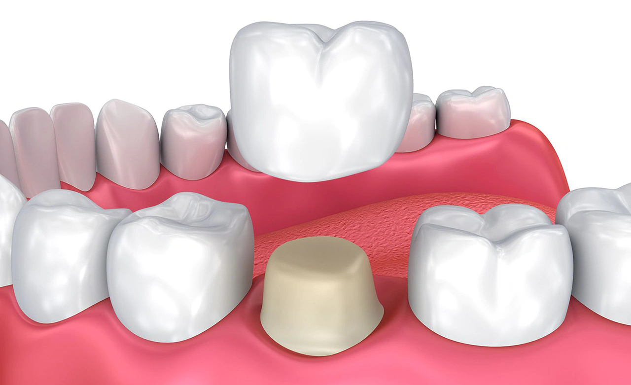 LIU-7694954718383-couronne de dents Couronne dentaire temporaire de dents,  70PCS/sac dents placages résine antérieure supérieure par - Cdiscount Au  quotidien