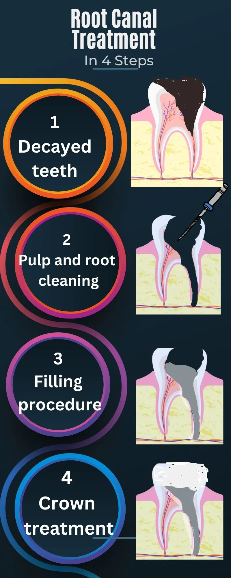 Root Canal Treatment in Antalya Turkey